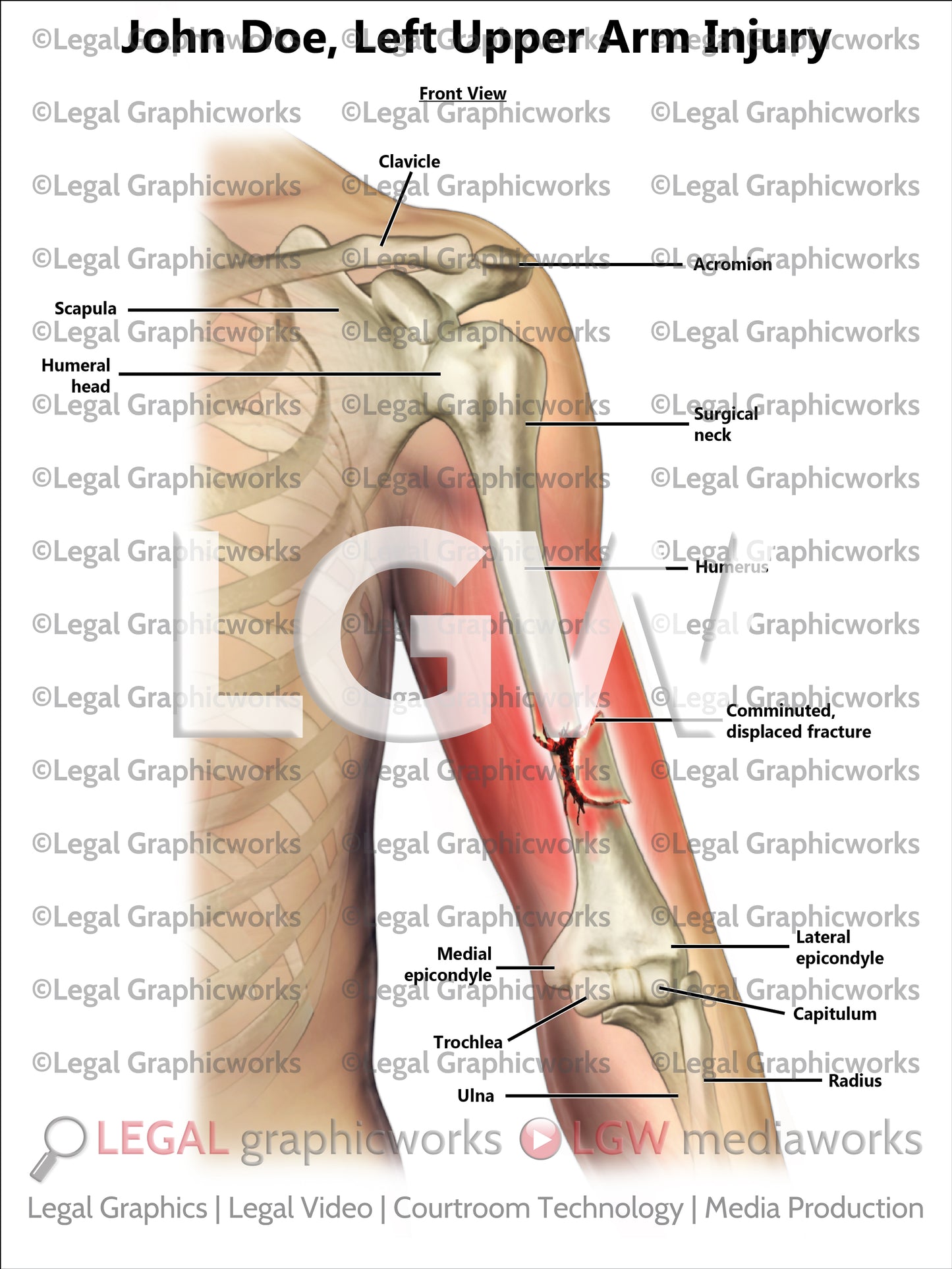 Left Upper Arm Injury