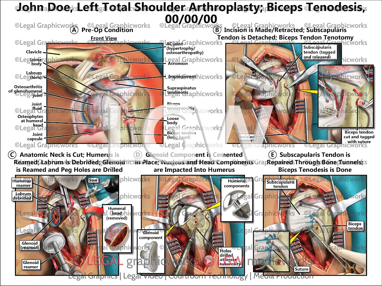 Left Total Shoulder Arthroplasty; Biceps Tenodesis
