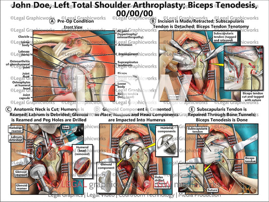 Left Total Shoulder Arthroplasty; Biceps Tenodesis
