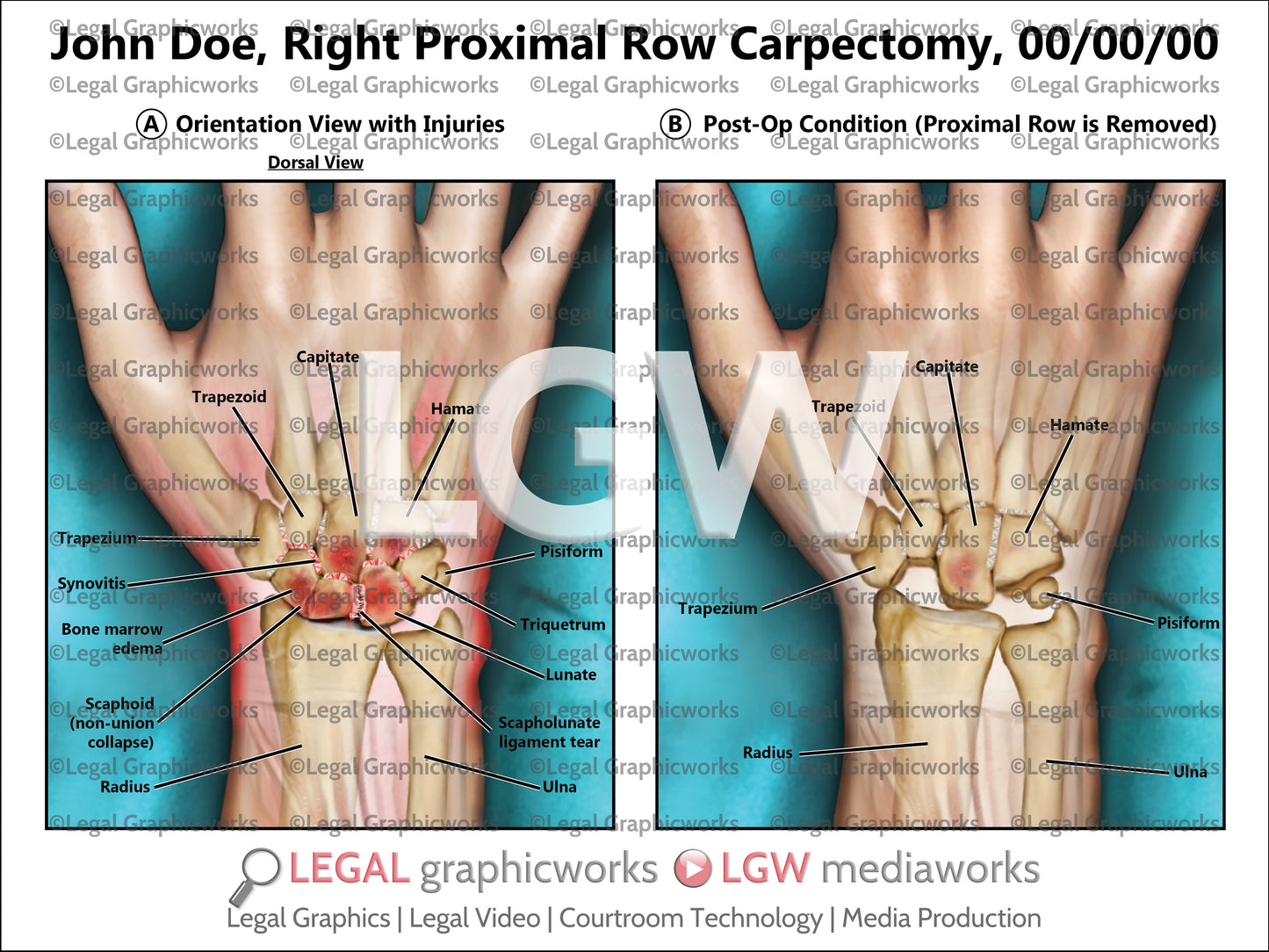 Right Proximal Row Carpectomy