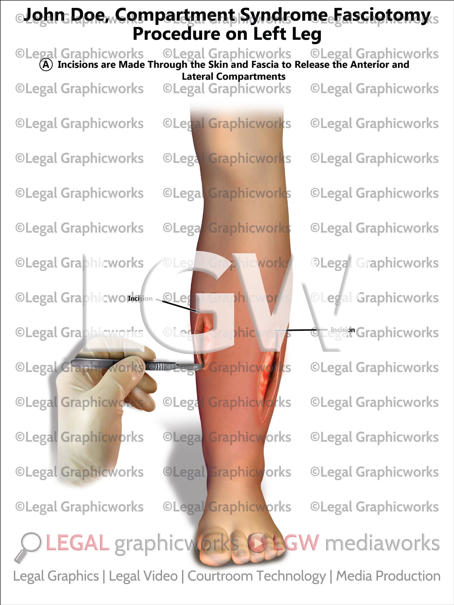Compartment Syndrome Fasciotomy Procedure on Left Leg