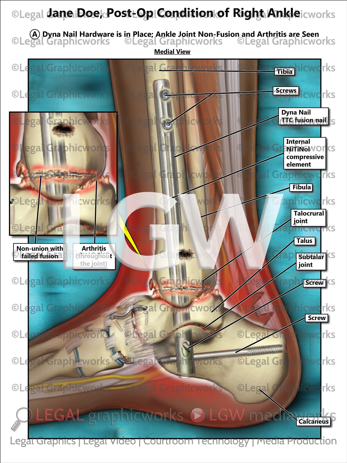 Post-Op Condition of Right Ankle