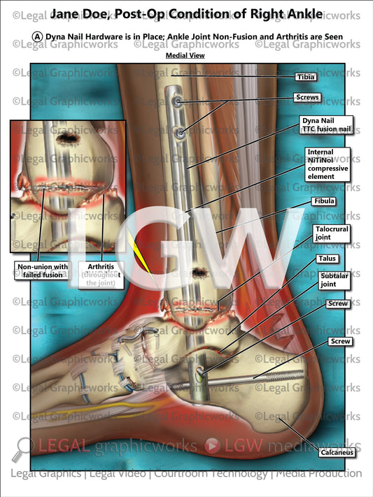 Post-Op Condition of Right Ankle