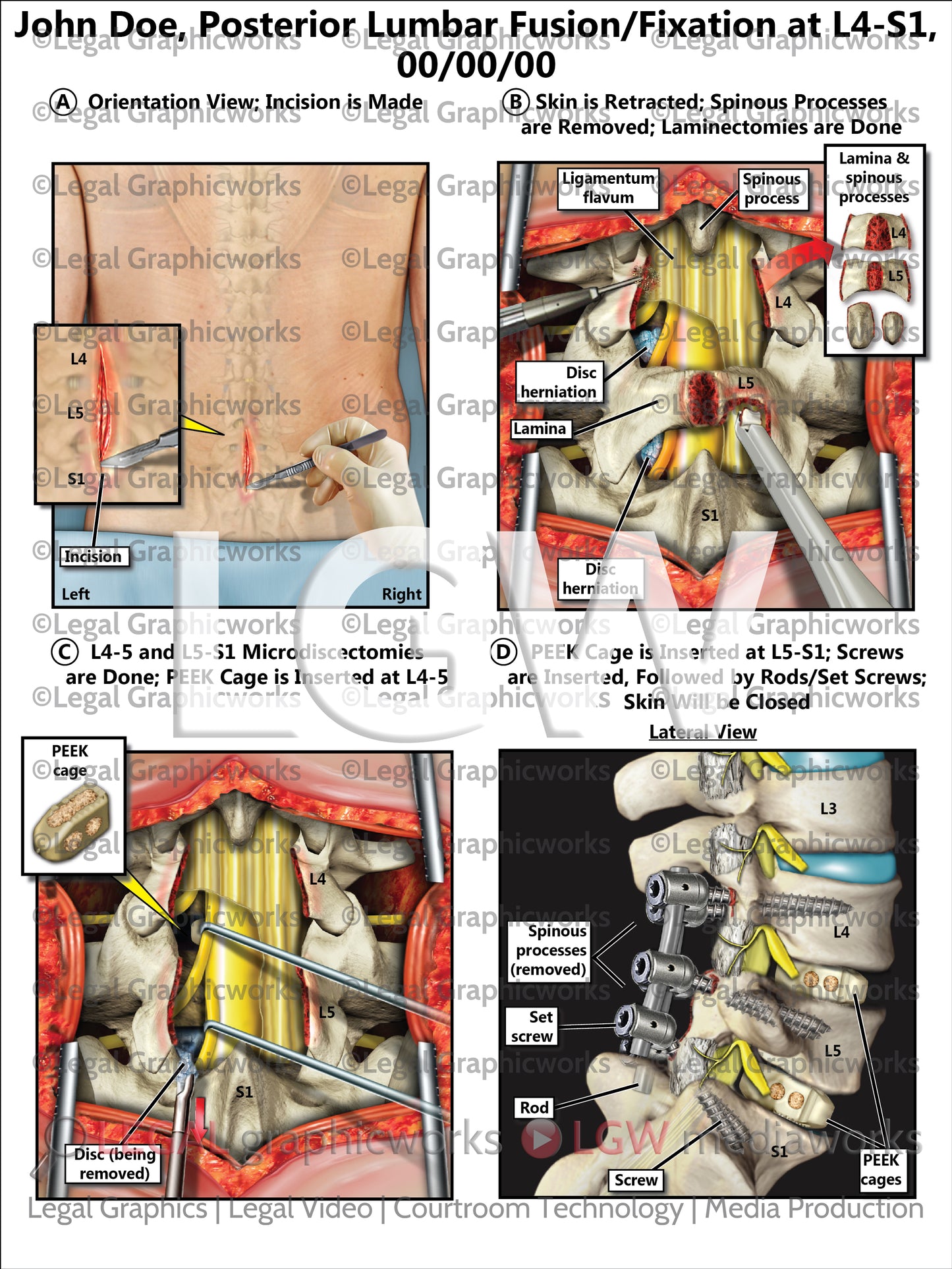 Posterior Lumbar Fusion/Fixation at L4-S1