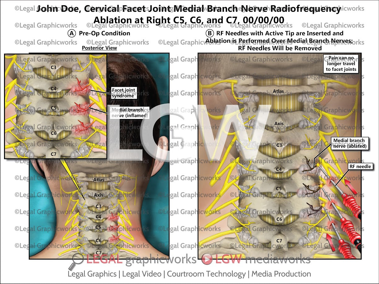 Cervical Facet Joint Medial Branch Nerve Radiofrequency Ablation at Right C5, C6, and C7