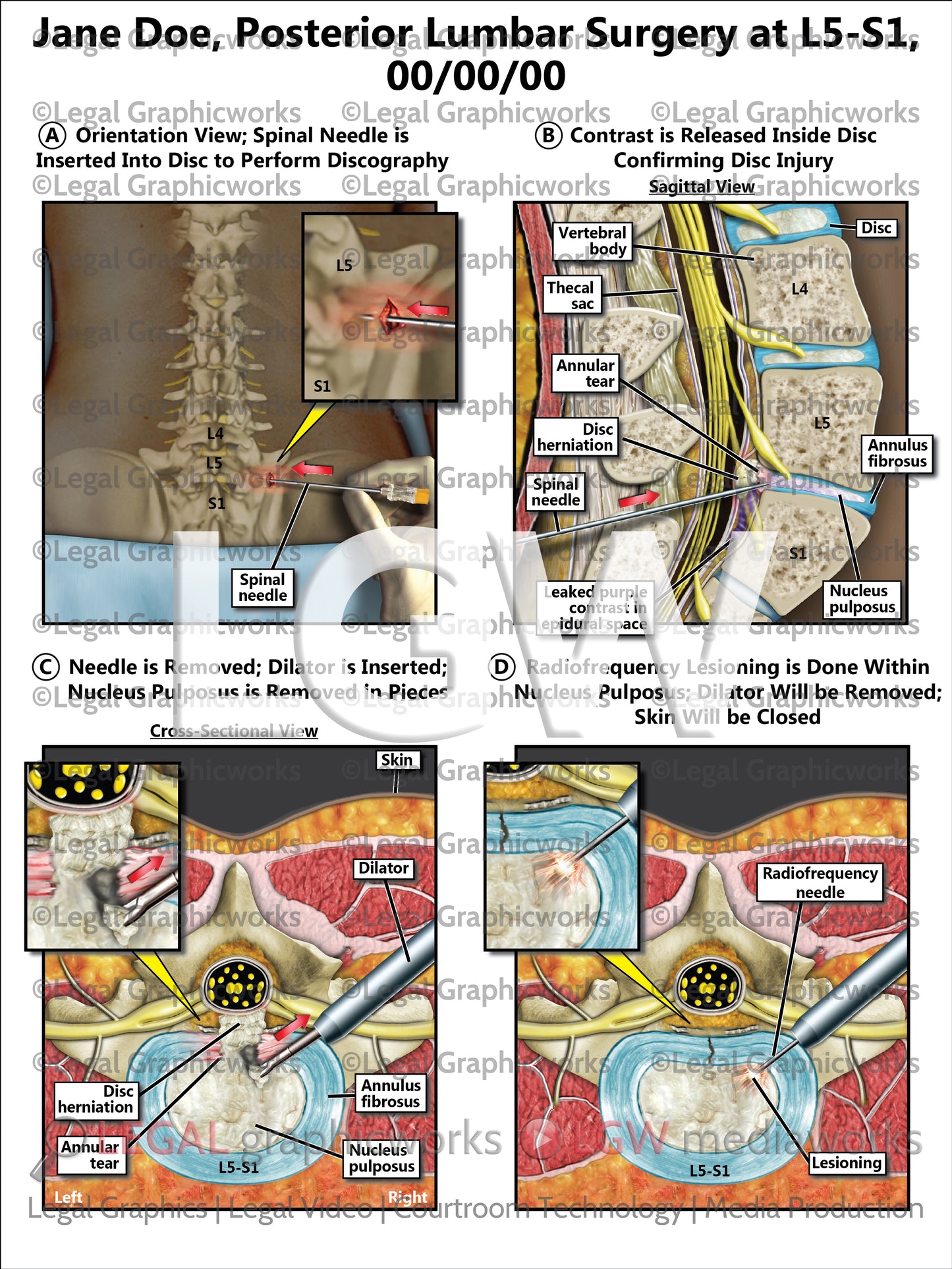 Posterior Lumbar Surgery at L5-S1