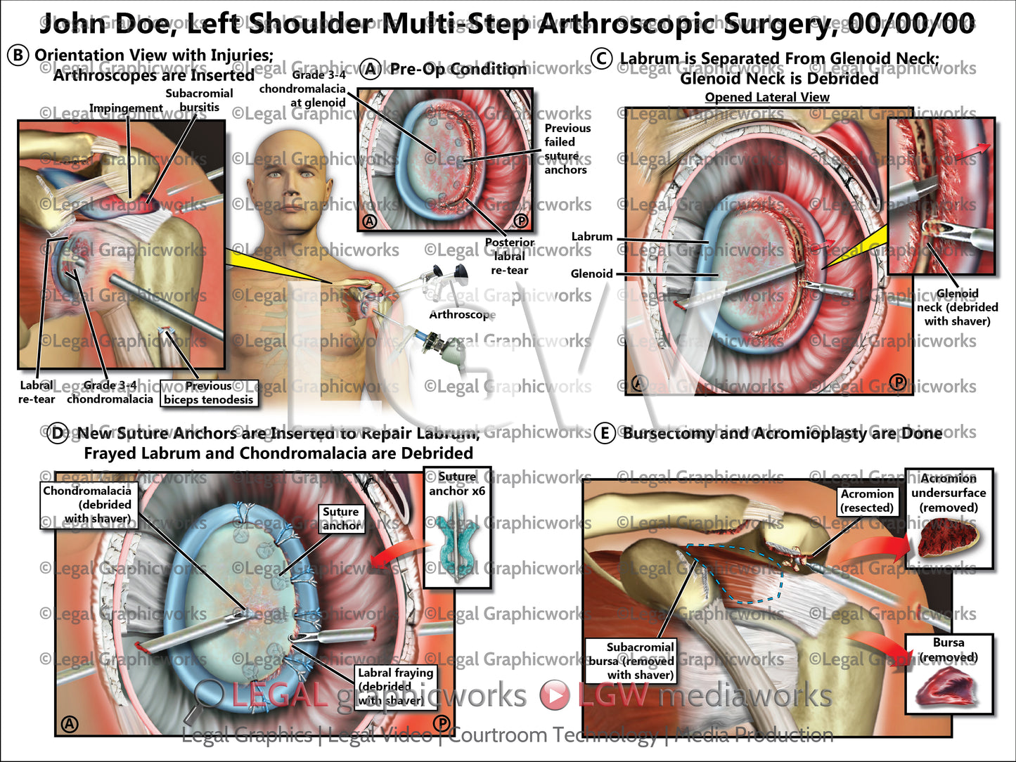 Left Shoulder Multi-Step Arthroscopic Surgery