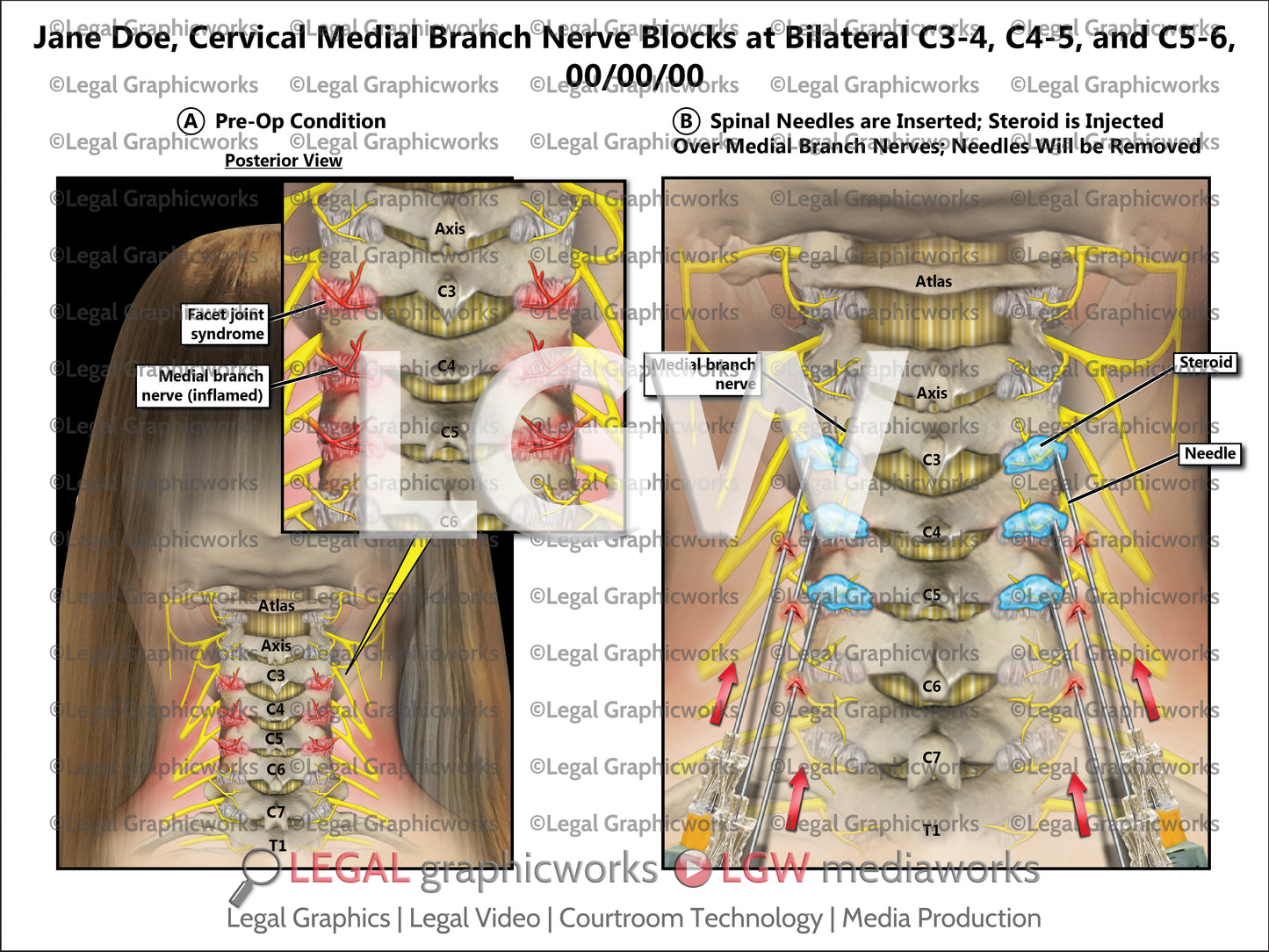 Cervical Medial Branch Nerve Blocks at Bilateral C3-4, C4-5, and C5-6