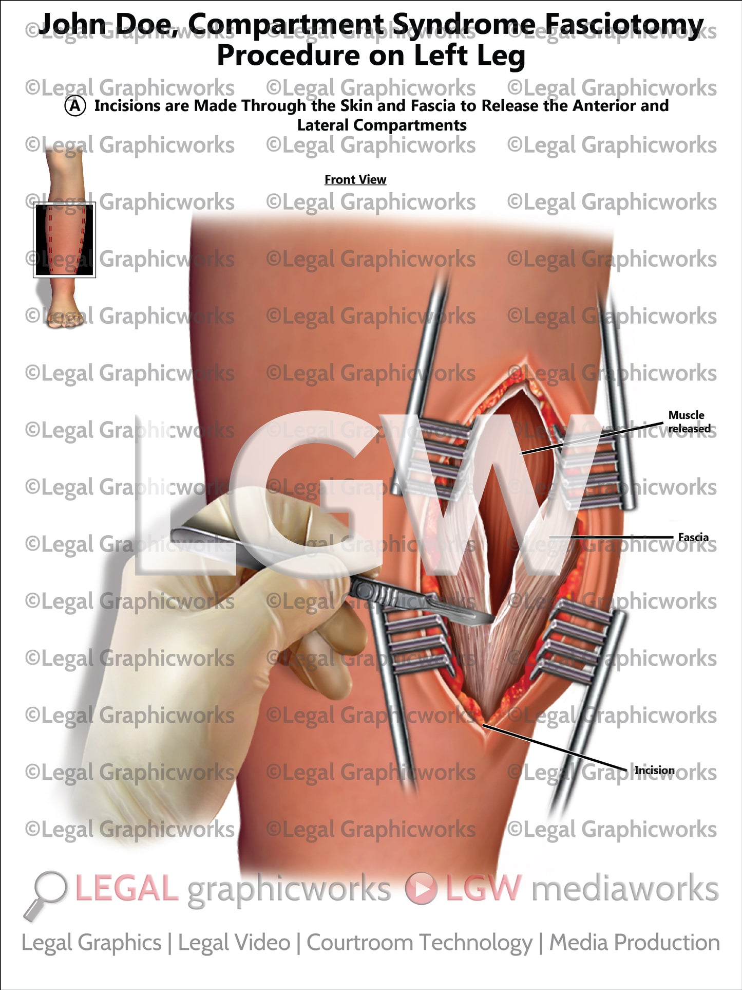 Compartment Syndrome Fasciotomy Procedure on Left Leg