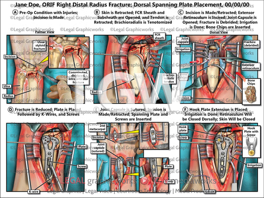 ORIF Right Distal Radius Fracture; Dorsal Spanning Plate Placement