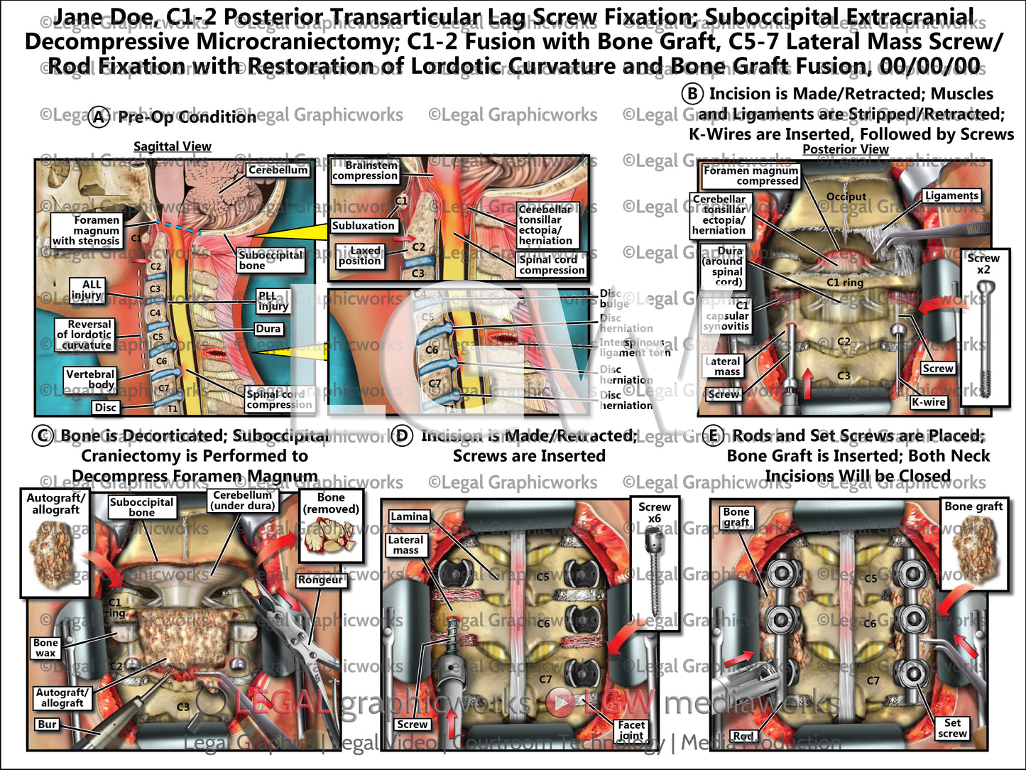 C1-2 Posterior Transarticular Lag Screw Fixation; Suboccipital Extracranial Decompressive Microcraniectomy; C1-2 Fusion with Bone Graft, C5-7 Lateral Mass Screw/Rod Fixation with Restoration of Lordotic Curvature and Bone Graft Fusion