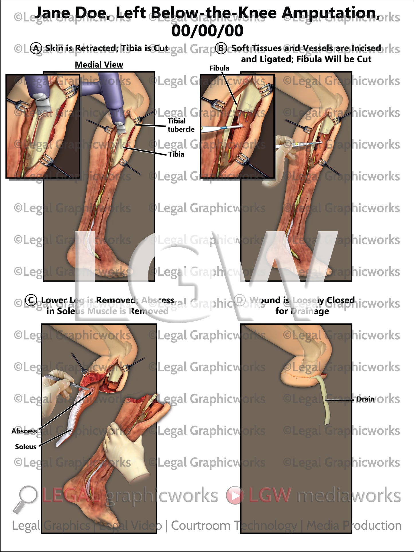 Left Below-the-Knee Amputation