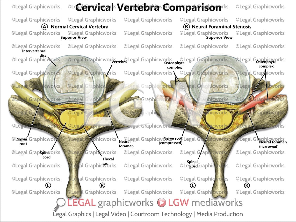 Cervical Vertebra Comparison