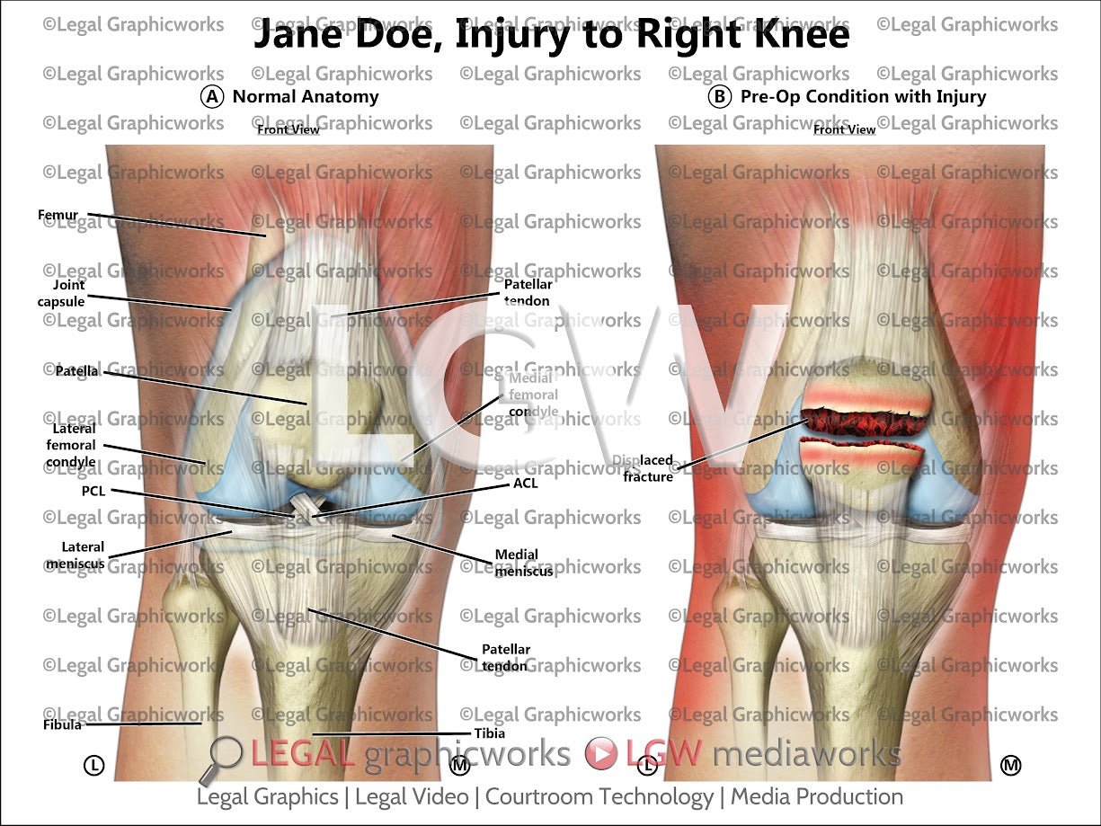 Injury to Right Knee