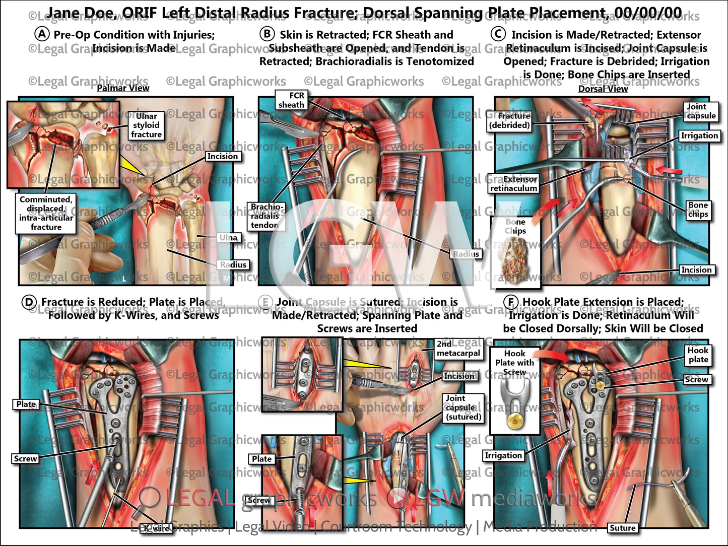ORIF Left Distal Radius Fracture; Dorsal Spanning Plate Placement
