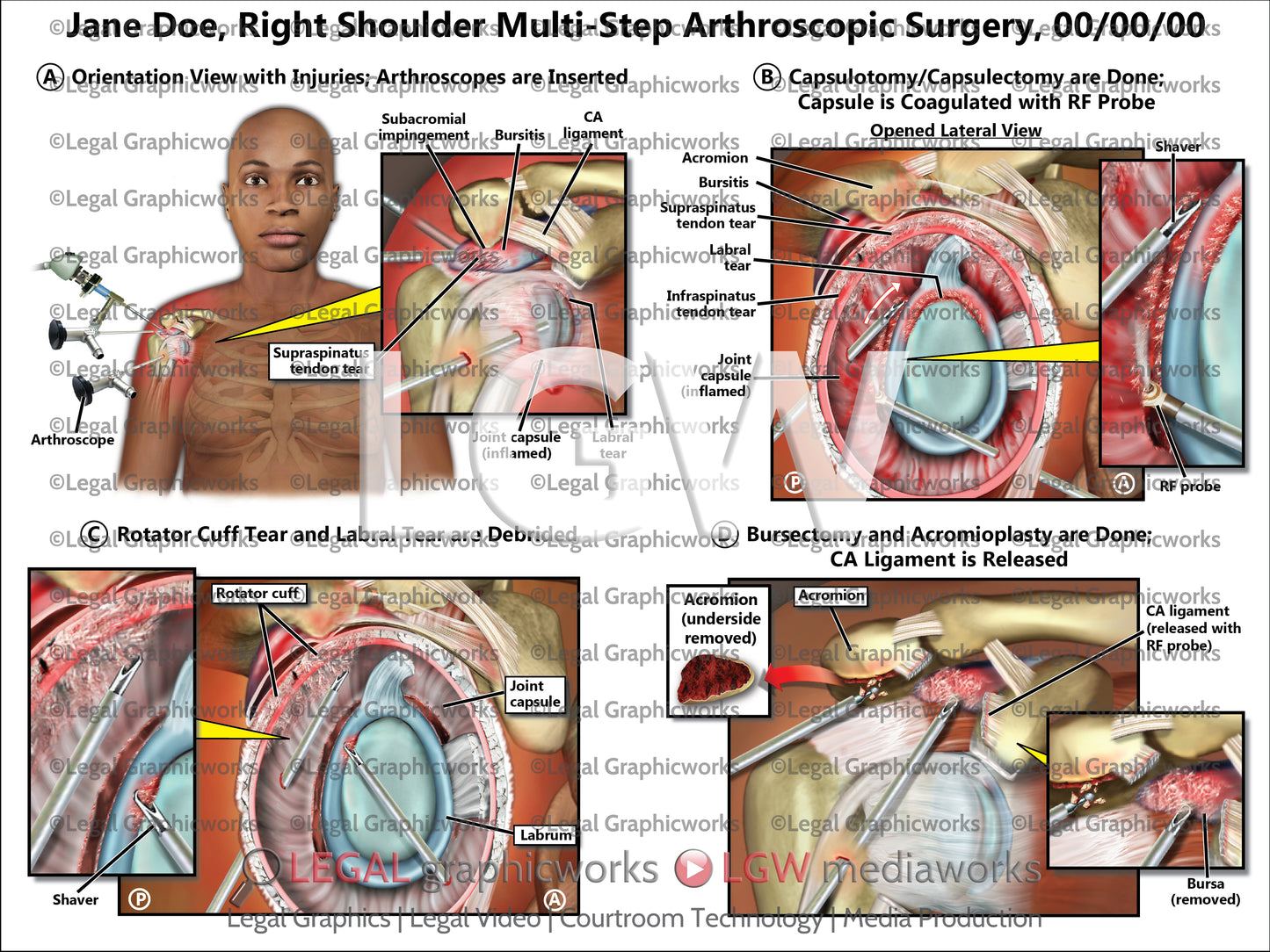 Right Shoulder Multi-Step Arthroscopic Surgery