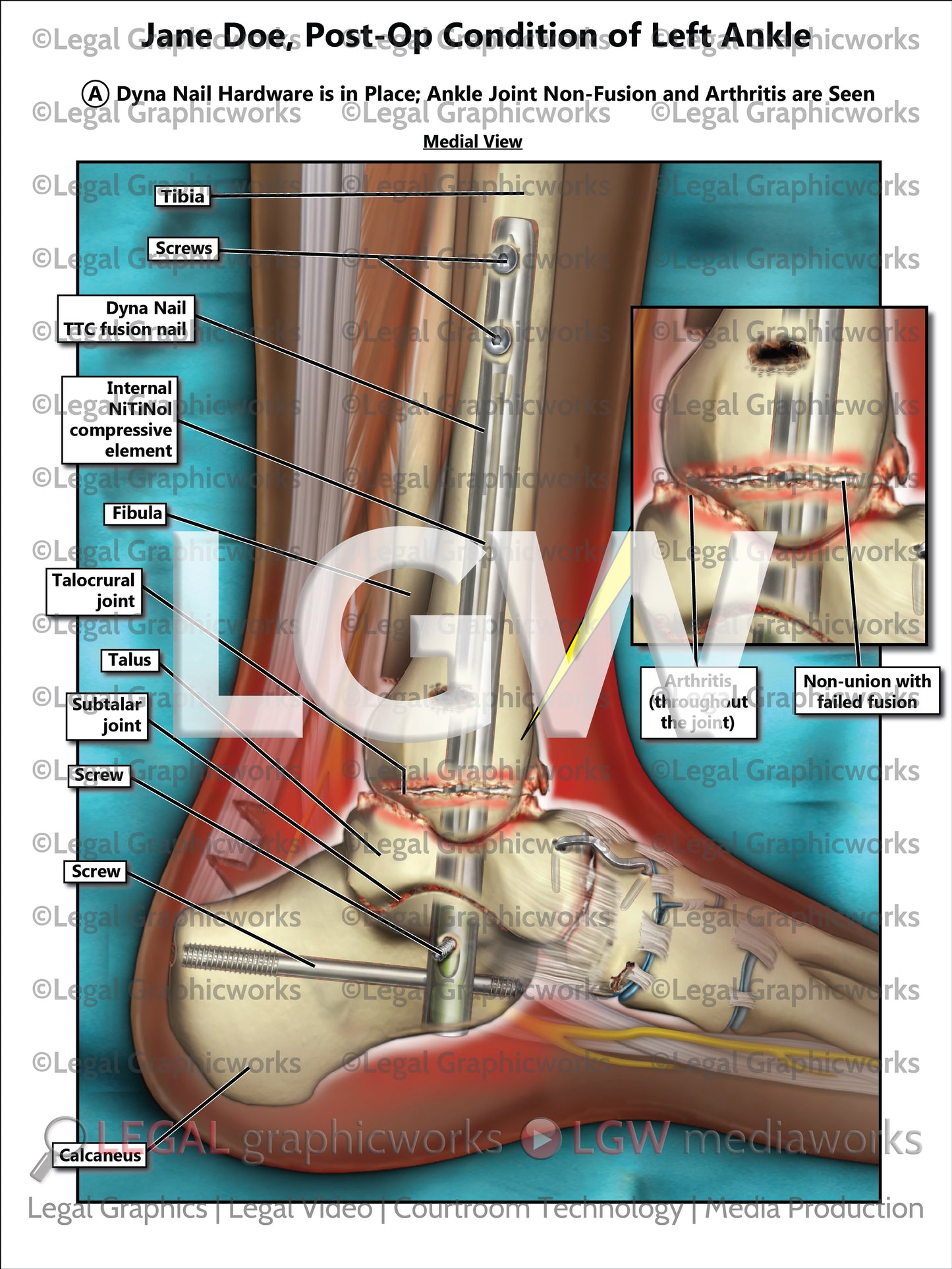 Post-Op Condition of Left Ankle