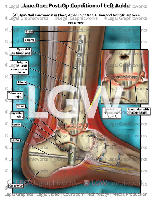 Post-Op Condition of Left Ankle