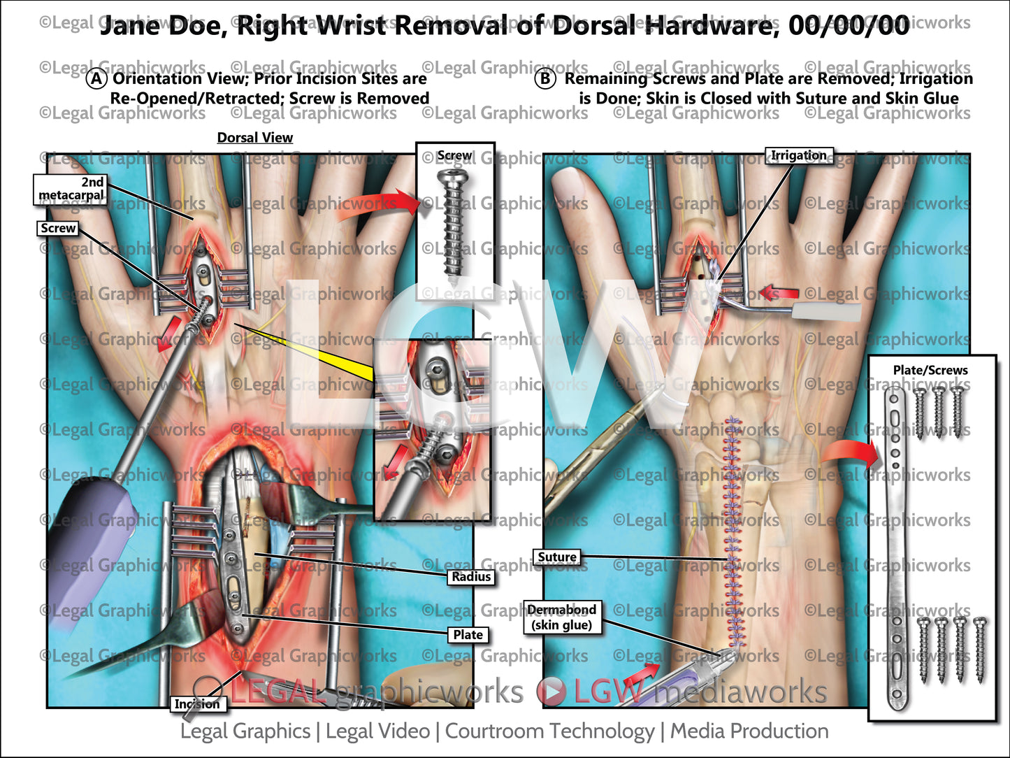 Right Wrist Removal of Dorsal Hardware