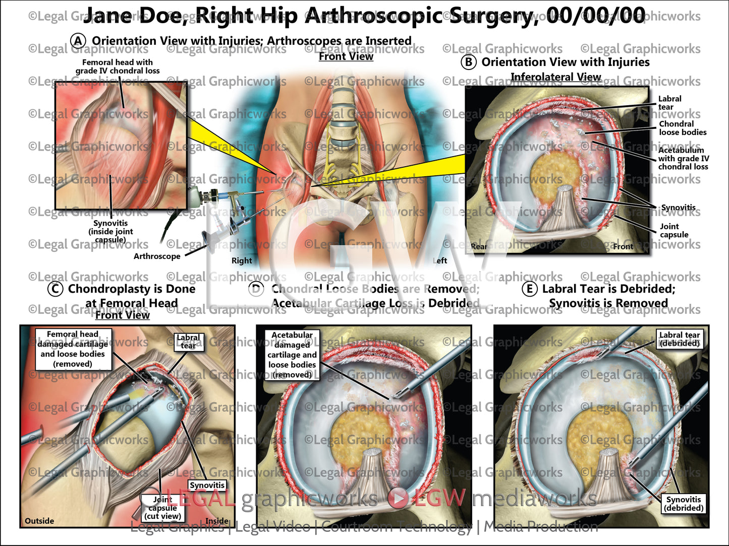 Right Hip Arthroscopic Surgery