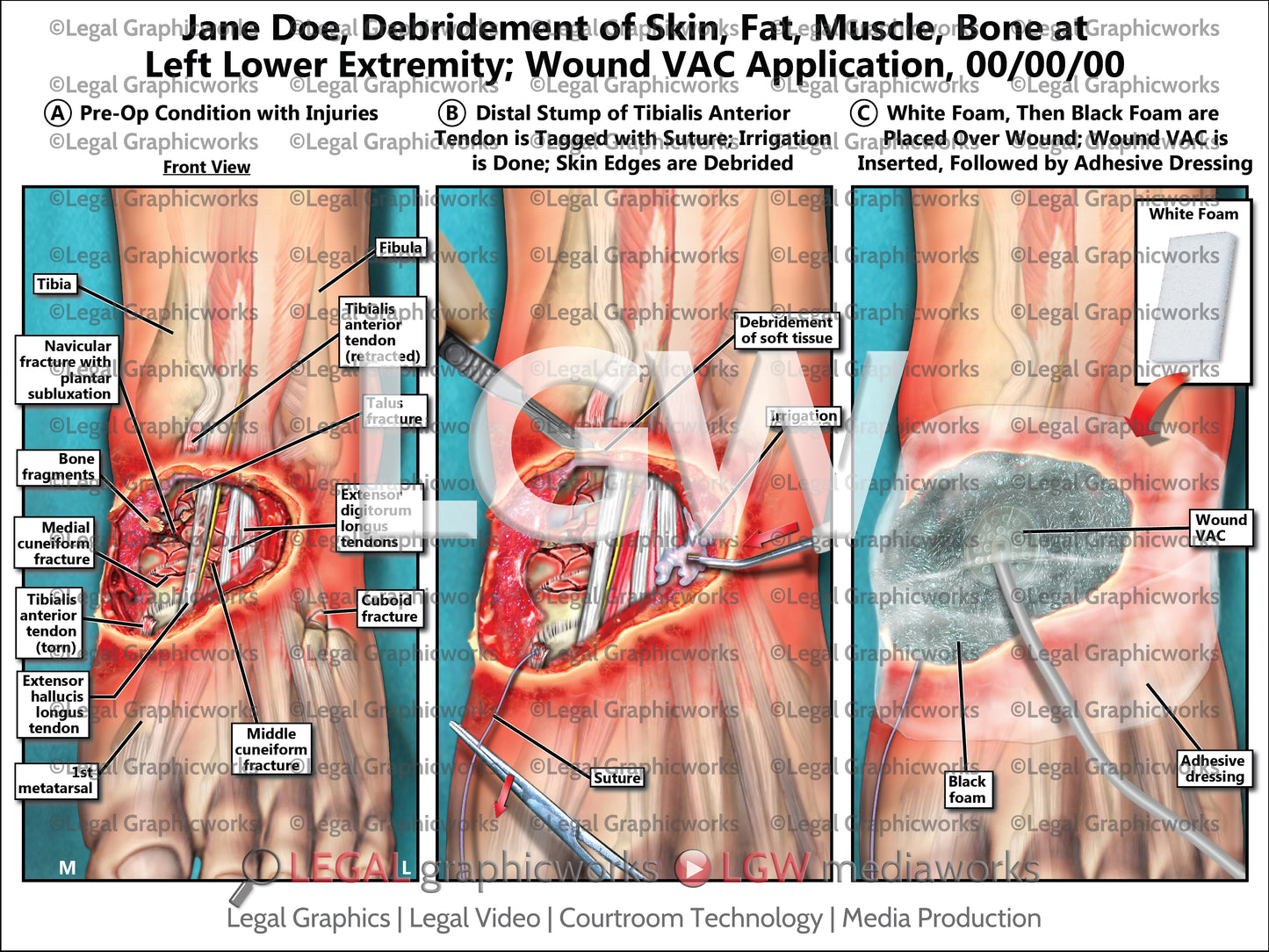 Debridement of Skin, Fat, Muscle, Bone at Left Lower Extremity; Wound VAC Application