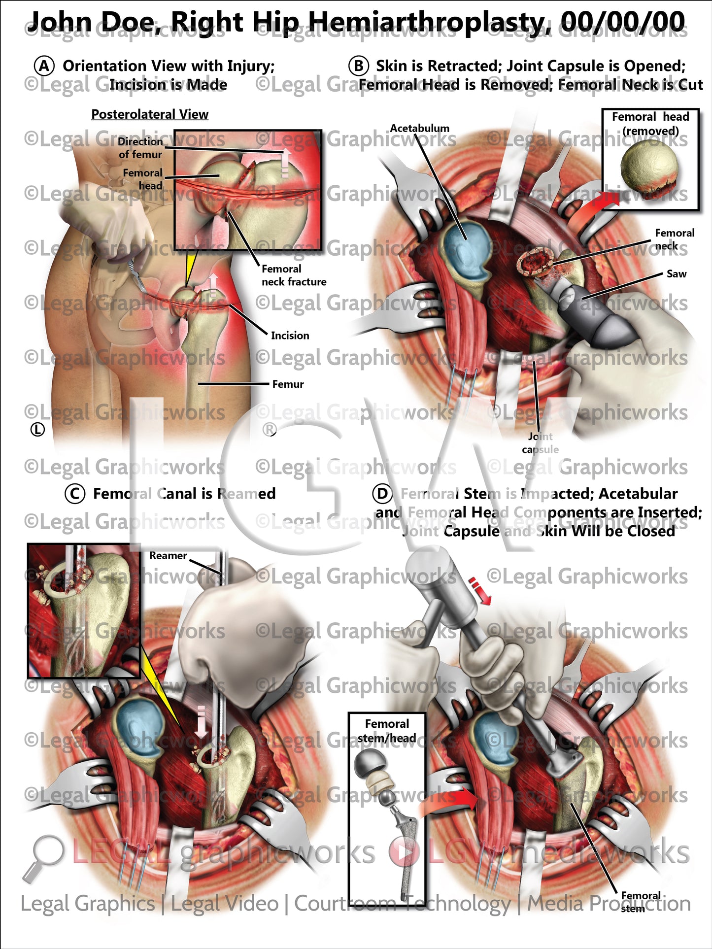 Right Hip Hemiarthroplasty