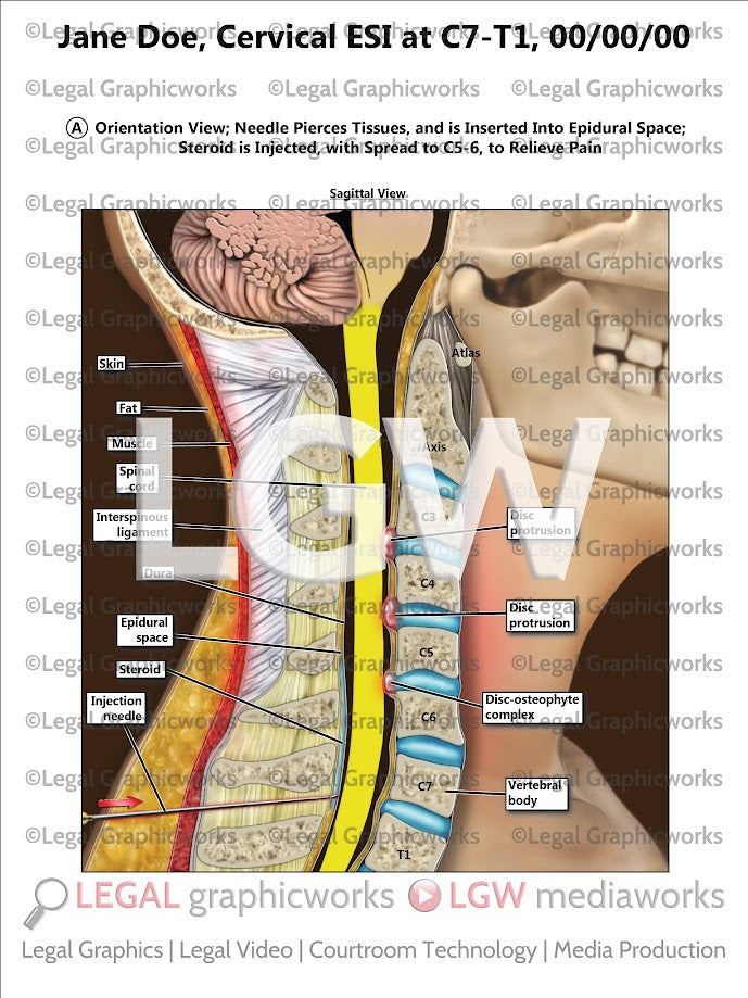 Cervical ESI at C7-T1