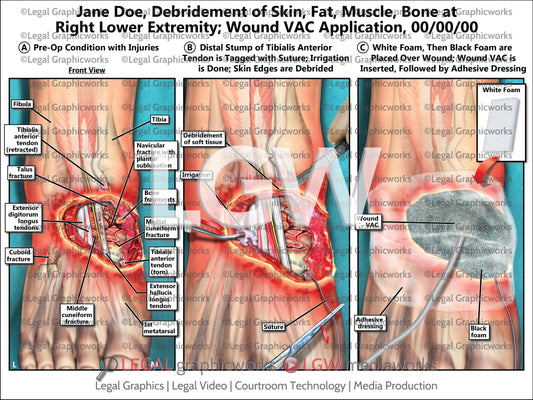 Debridement of Skin, Fat, Muscle, Bone at Right Lower Extremity; Wound VAC Application