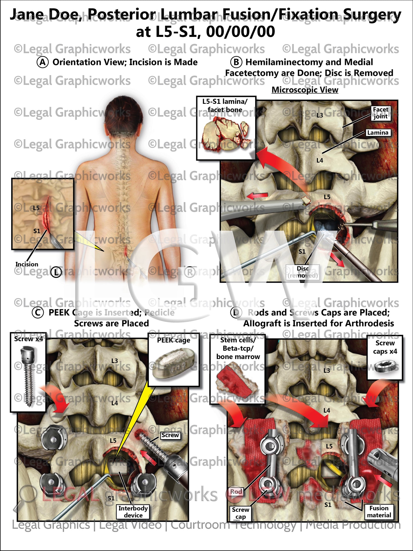 Posterior Lumbar Fusion/Fixation Surgery at L5-S1