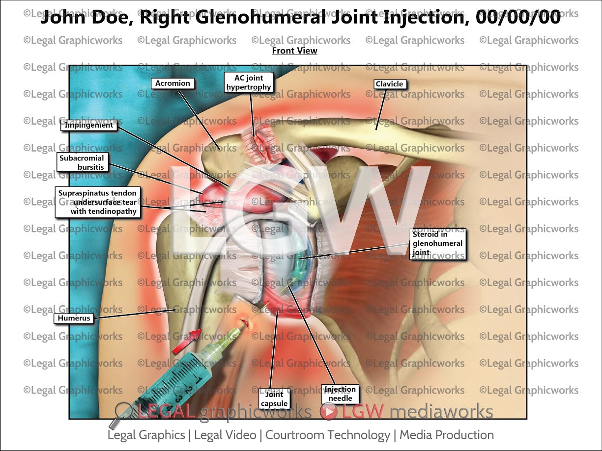 Right Glenohumeral Joint Injection