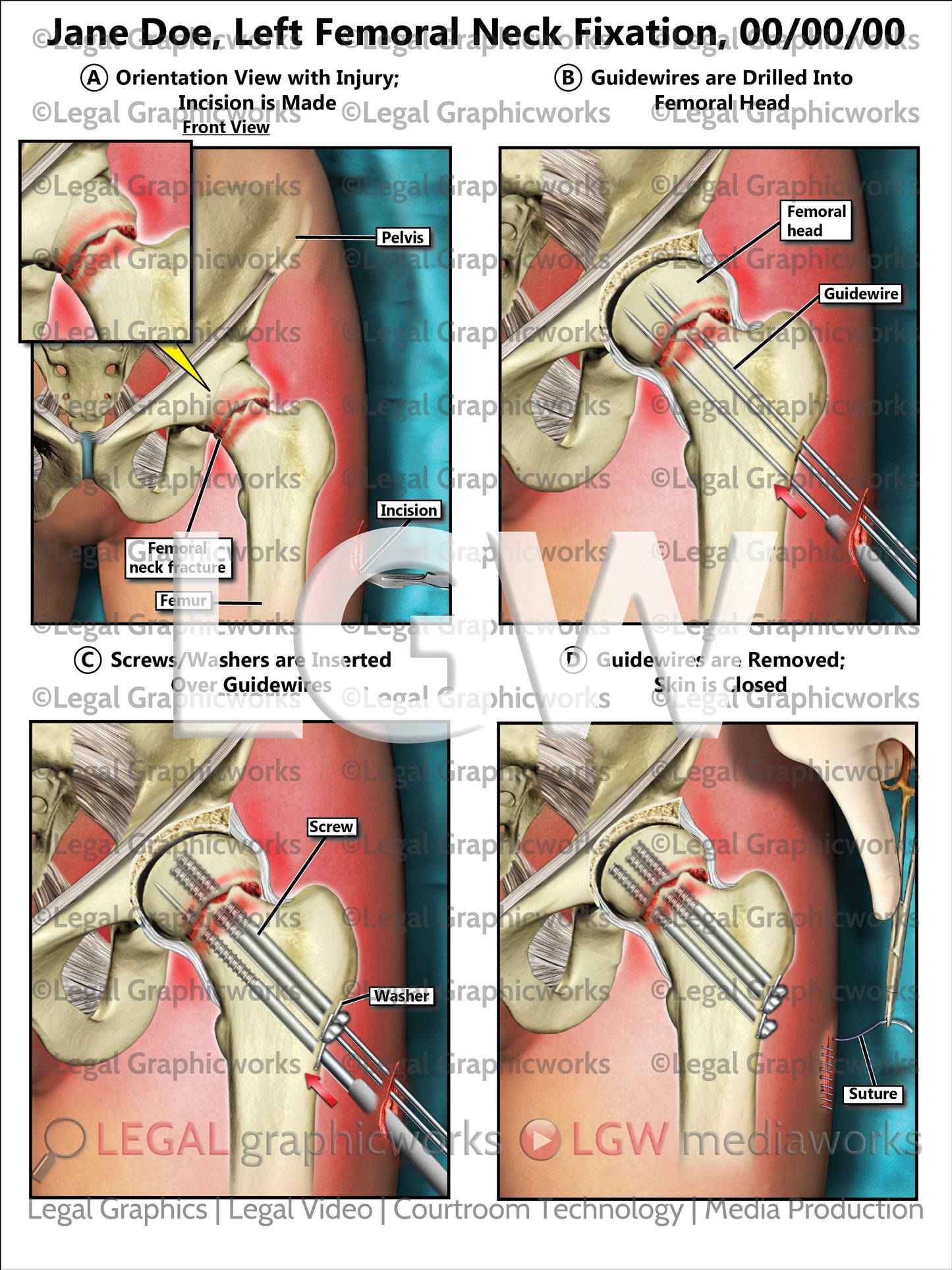 Left Femoral Neck Fixation