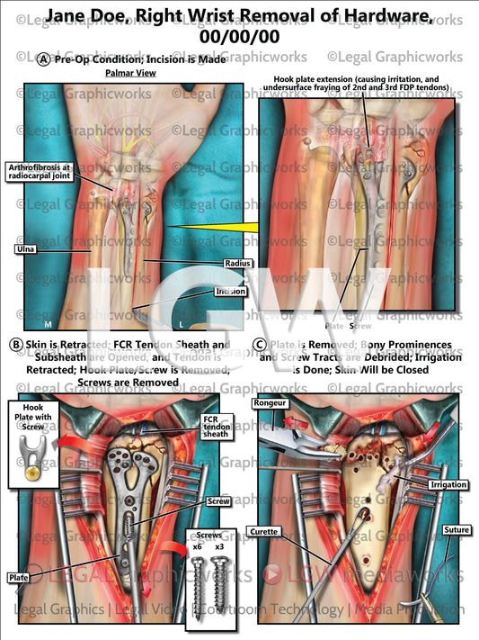 Right Wrist Removal of Hardware
