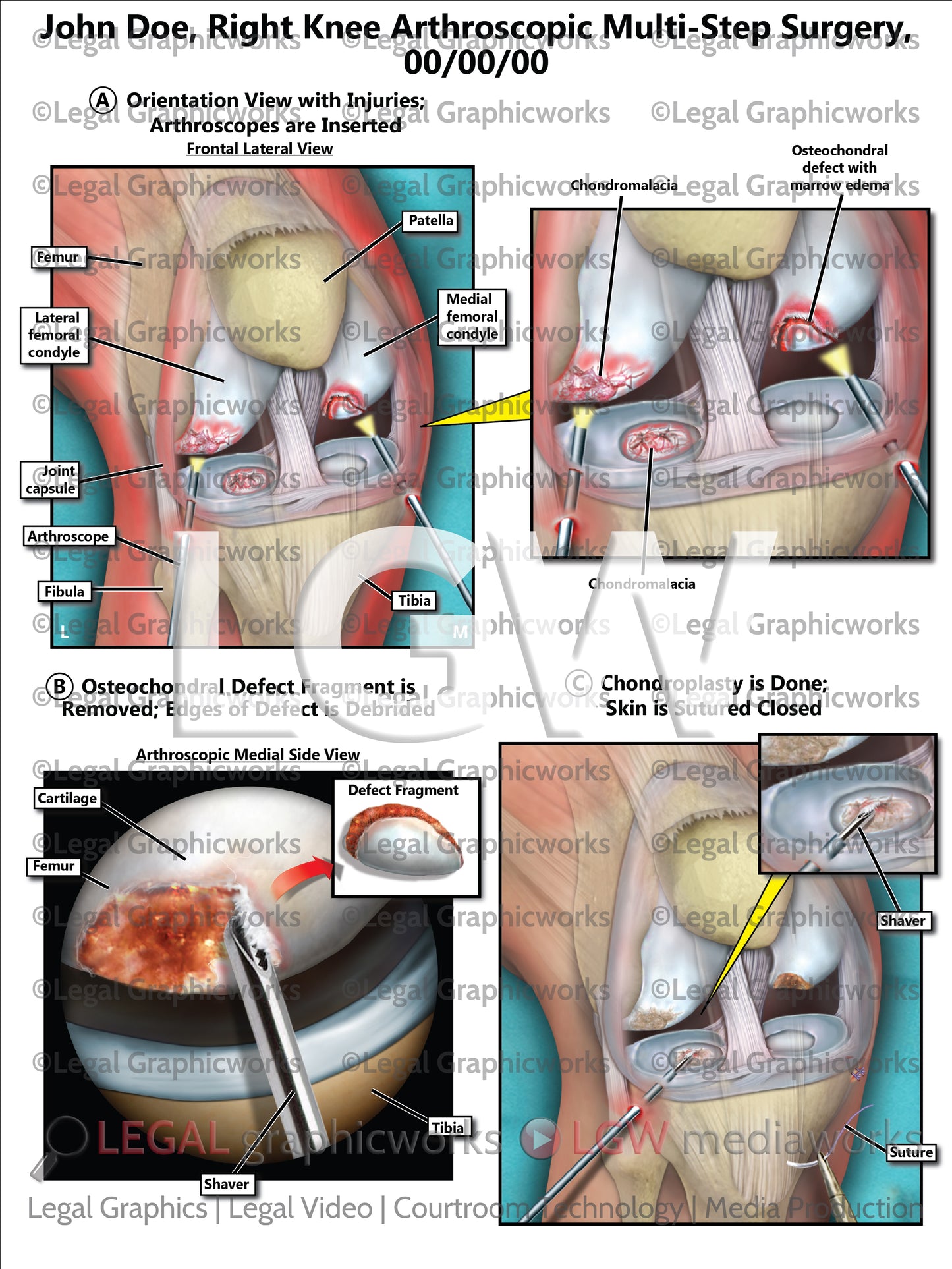 Right Knee Arthroscopic Multi-Step Surgery