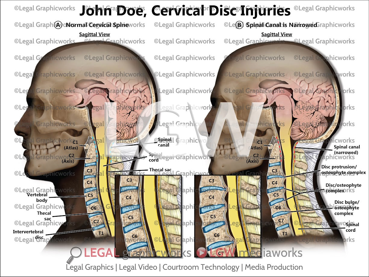 Cervical Disc Injuries