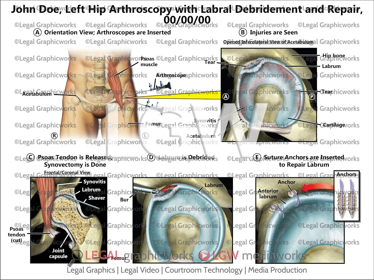 Left Hip Arthroscopy with Labral Debridement and Repair