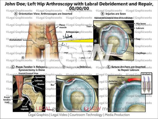 Left Hip Arthroscopy with Labral Debridement and Repair