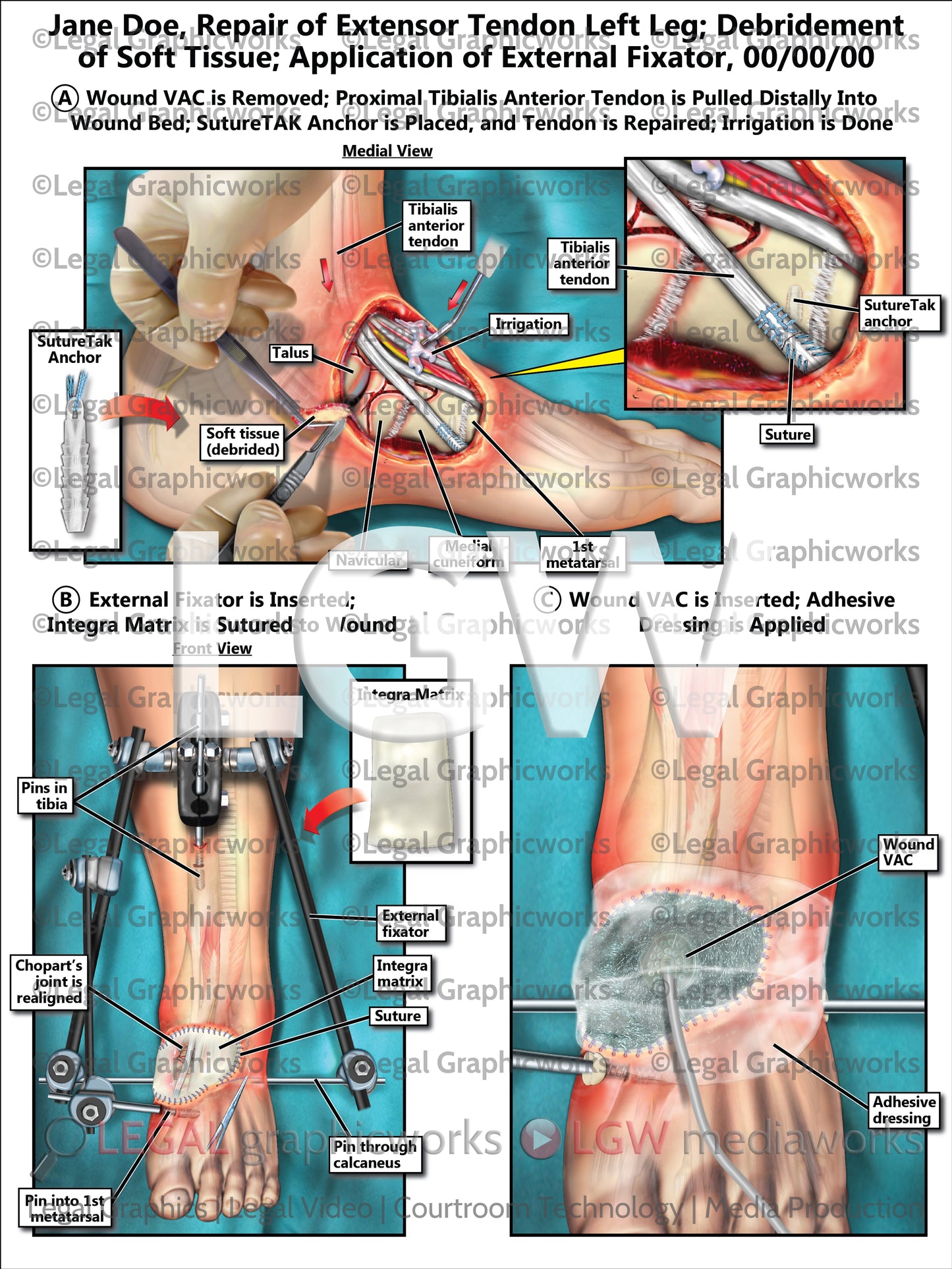 Repair of Extensor Tendon Left Leg; Debridement of Soft Tissue; Application of External Fixator