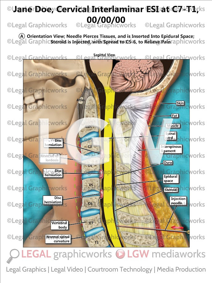 Cervical Interlaminar ESI at C7-T1