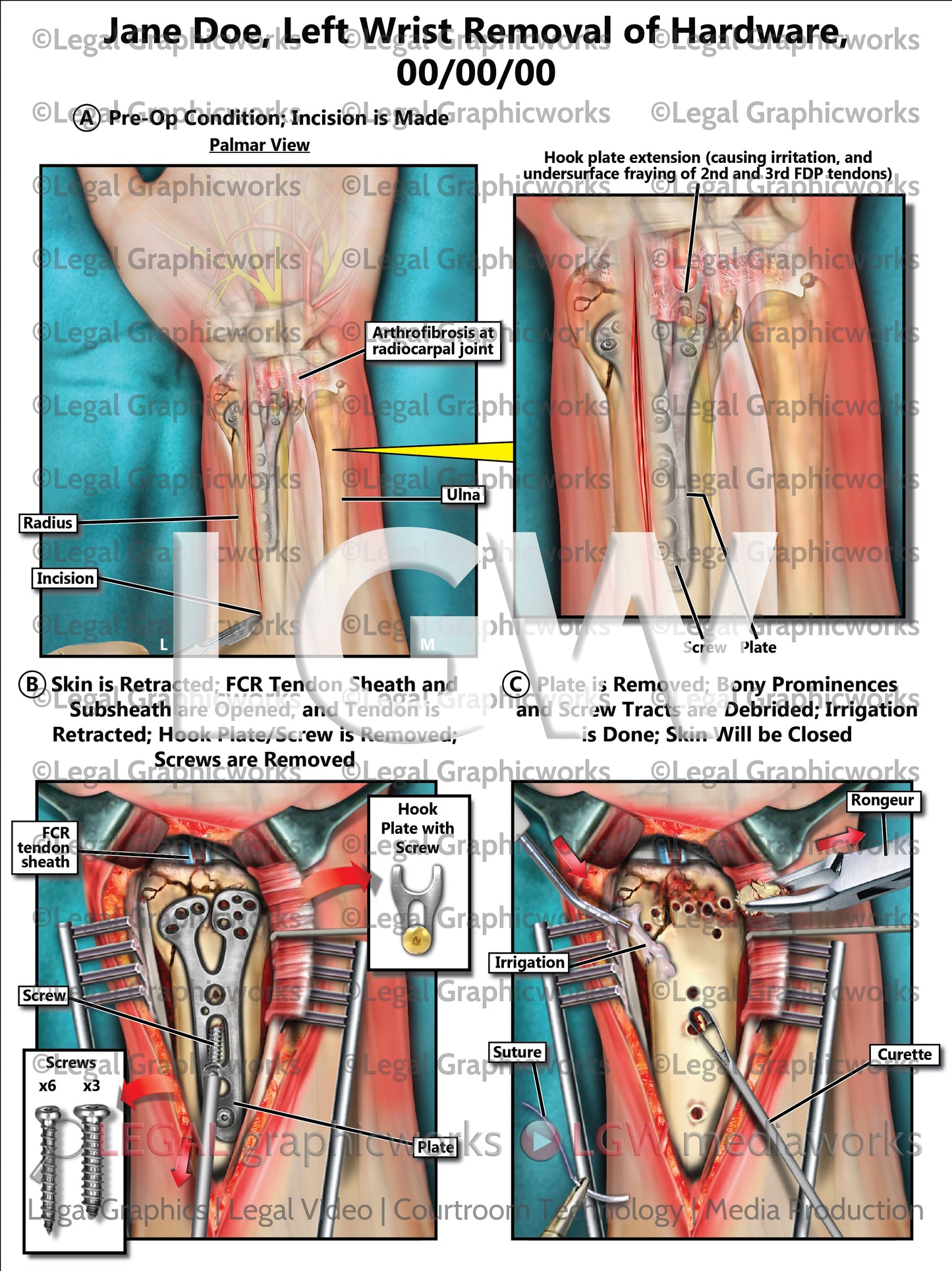 Left Wrist Removal of Hardware