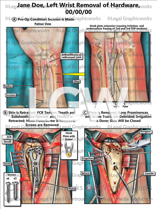 Left Wrist Removal of Hardware