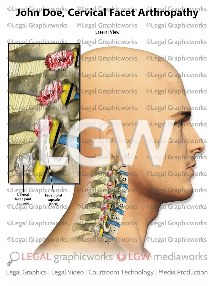 Cervical Facet Arthropathy