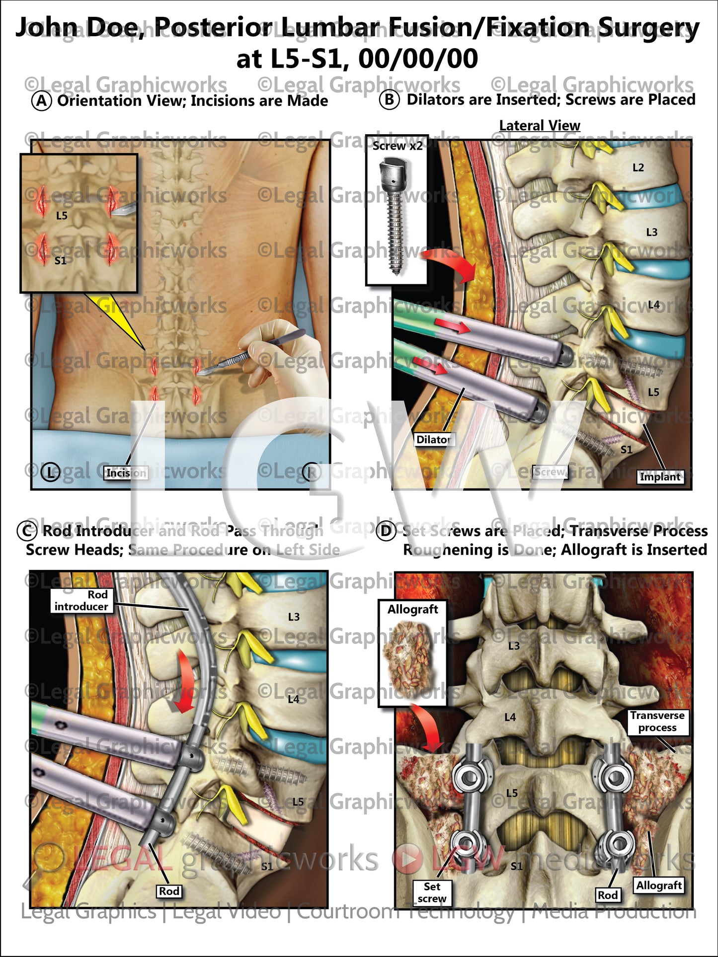 Posterior Lumbar Fusion/Fixation Surgery at L5-S1