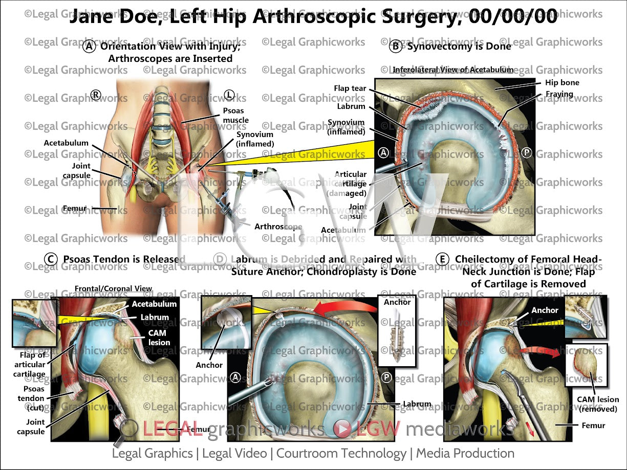 Left Hip Arthroscopic Surgery