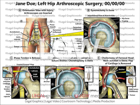 Left Hip Arthroscopic Surgery