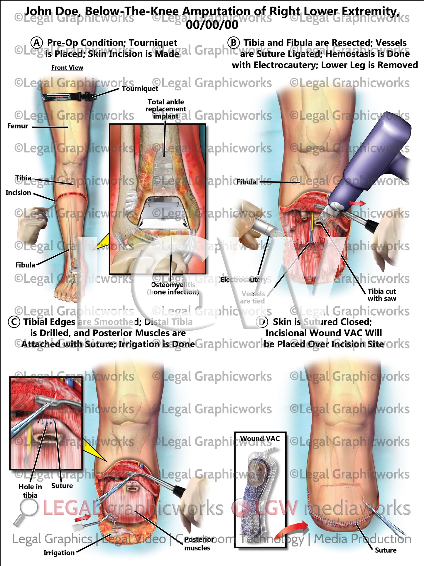 Below-the-Knee Amputation of Right Lower Extremity