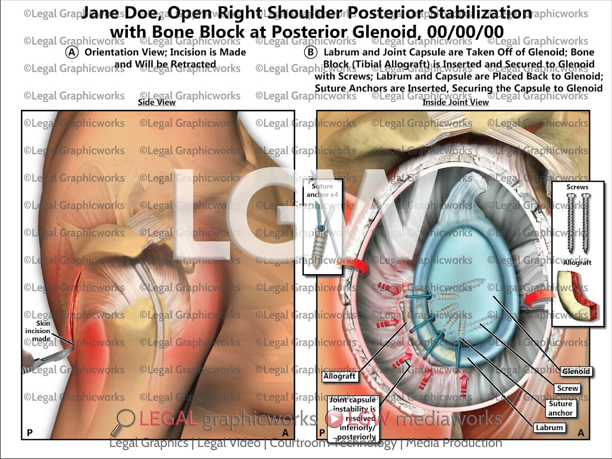 Open Right Shoulder Posterior Stabilization with Bone Block at Posterior Glenoid