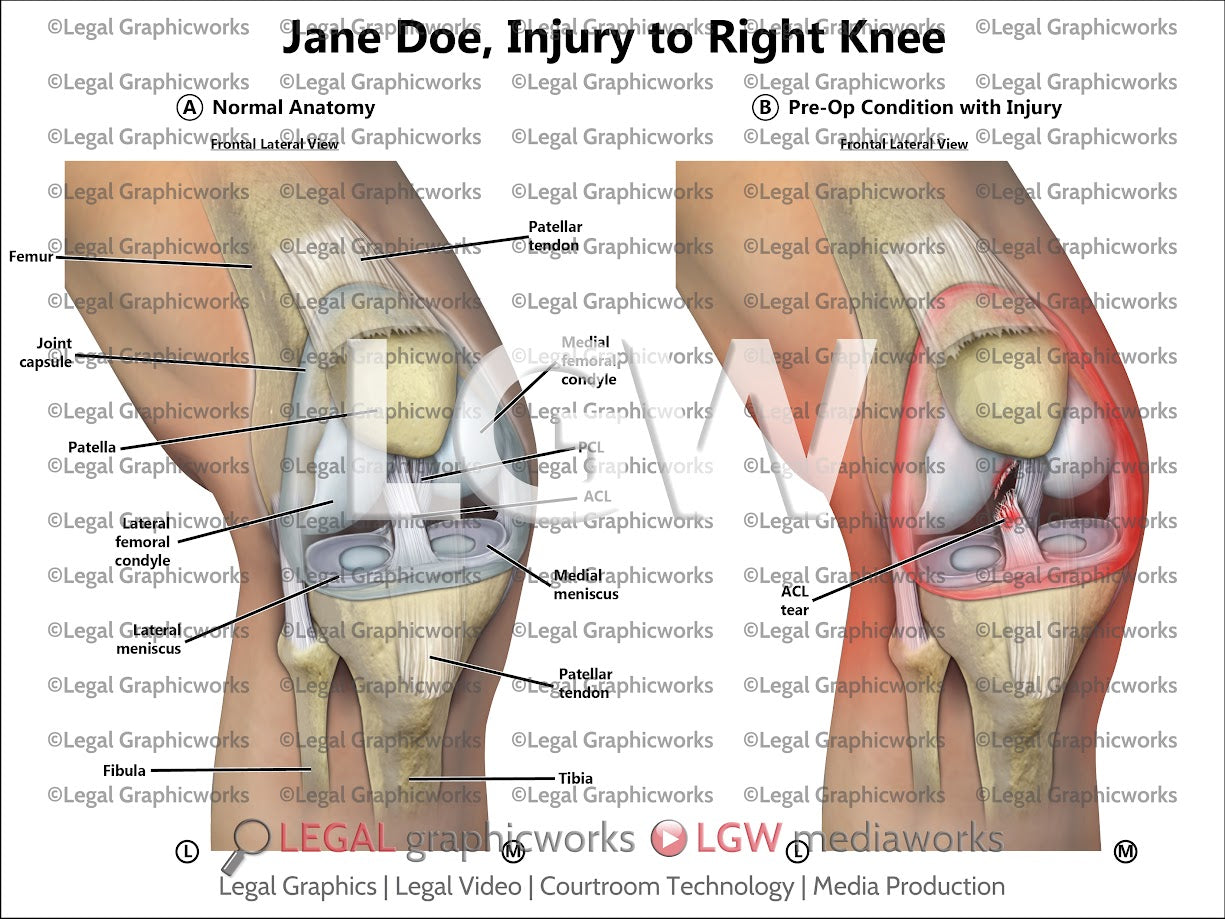 Injury to Right Knee