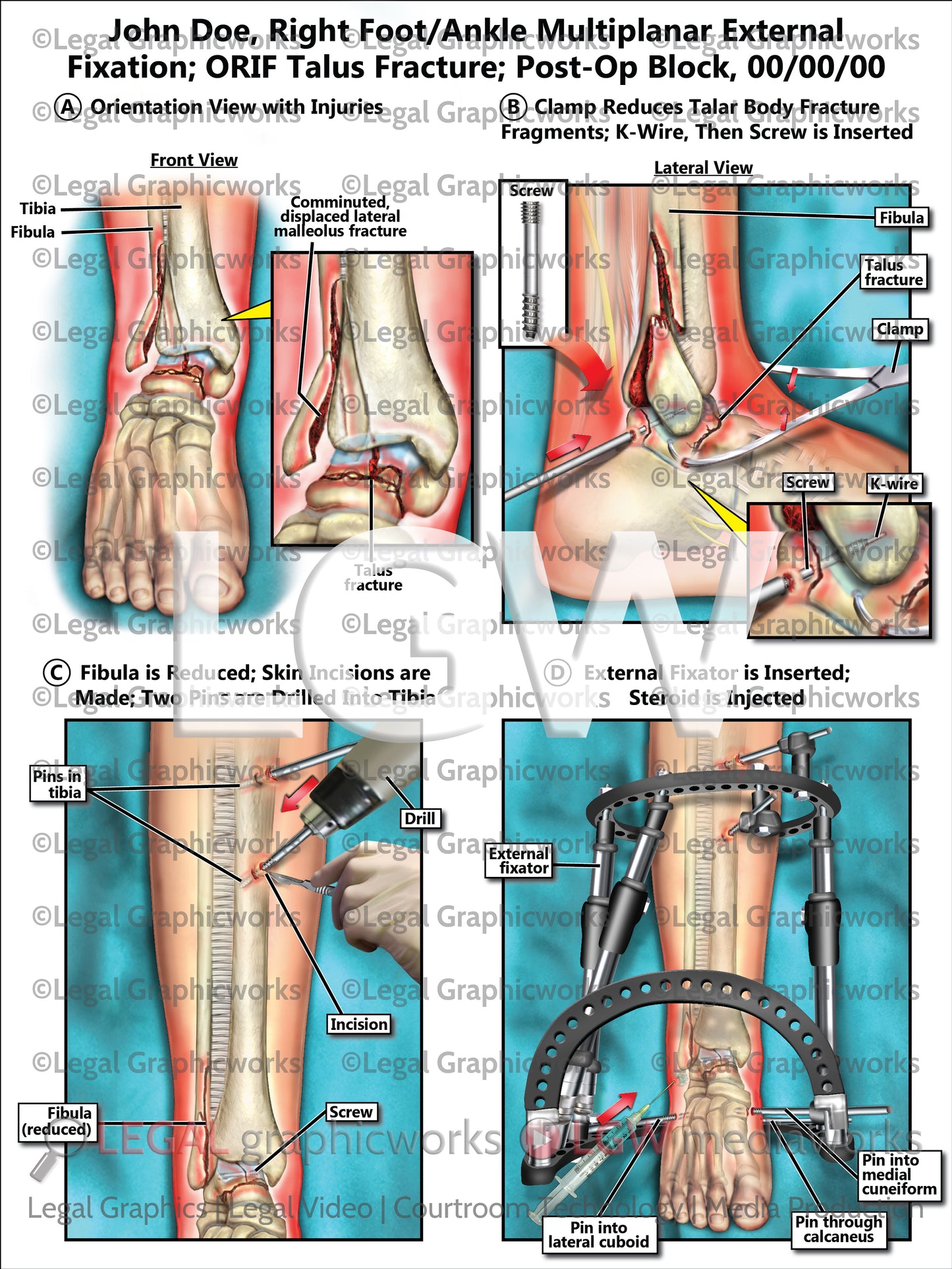 Right Foot/Ankle Multiplanar External Fixation; ORIF Talus Fracture; Post-Op Block