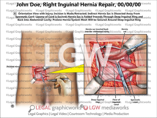 Right Inguinal Hernia Repair