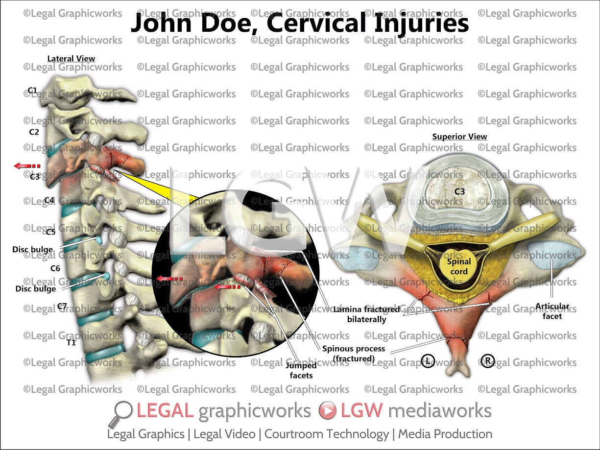 Cervical Injuries